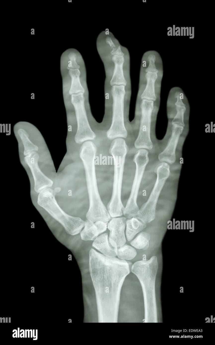 comminute fracture distal pharange of middle finger Stock Photo