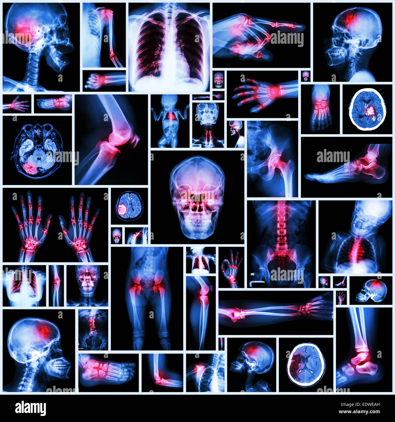 Collection X-ray multiple organ and arthritis at multiple joint (Rheumatoid,Gout) Stock Photo