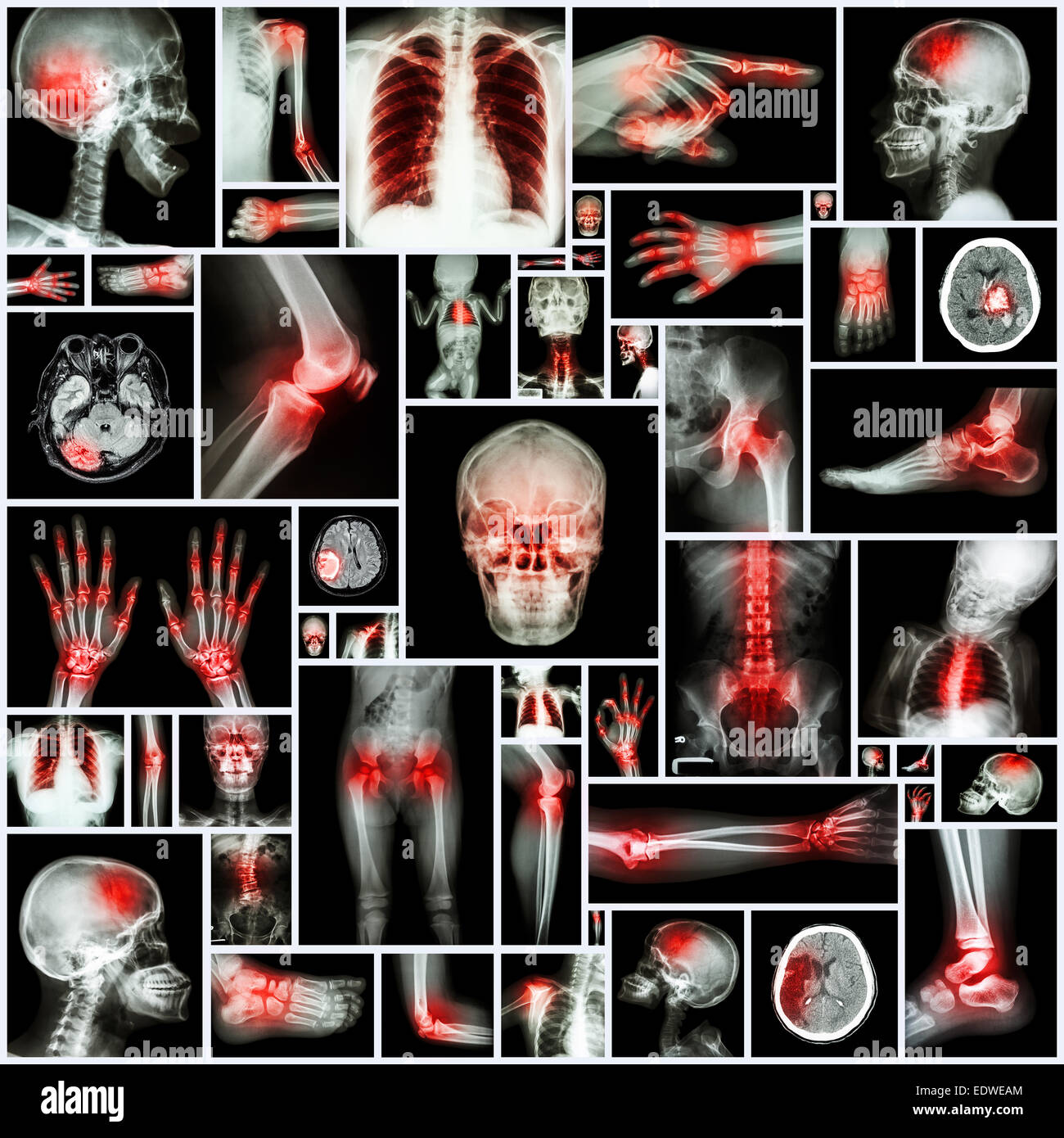Collection X-ray multiple organ and arthritis at multiple joint (Rheumatoid,Gout) Stock Photo