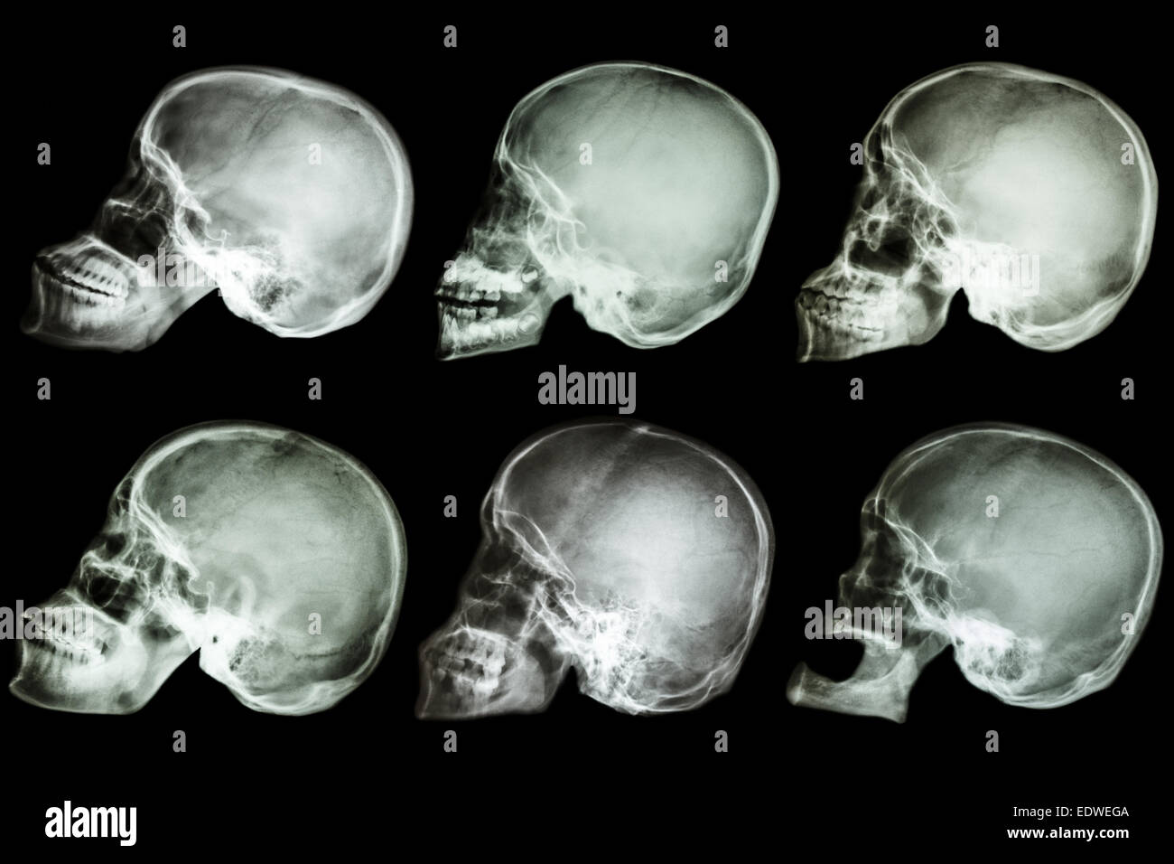 Collection of x-ray asian's skull Stock Photo