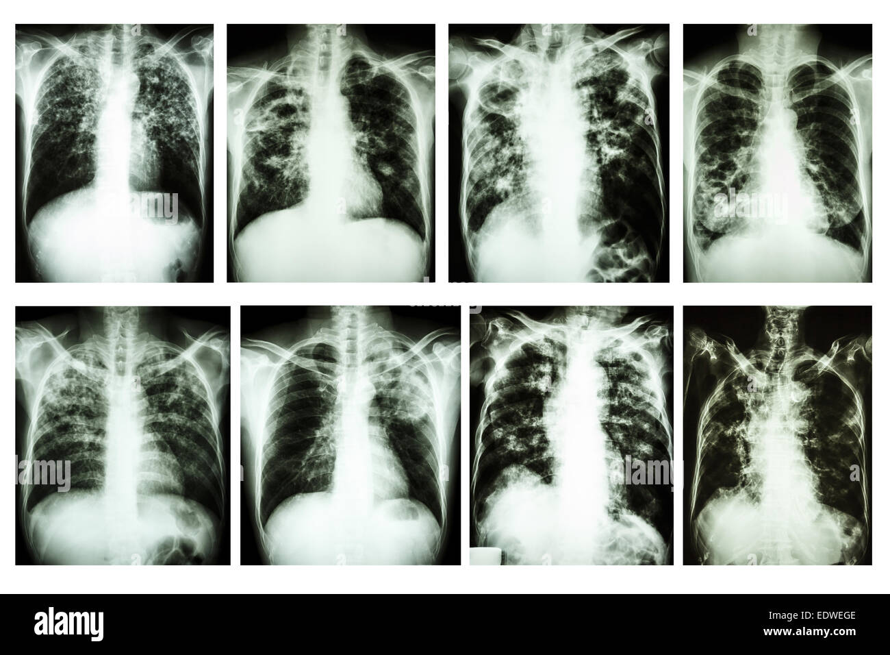 Collection of chest x-ray 'Pulmonary tuberculosis' Stock Photo