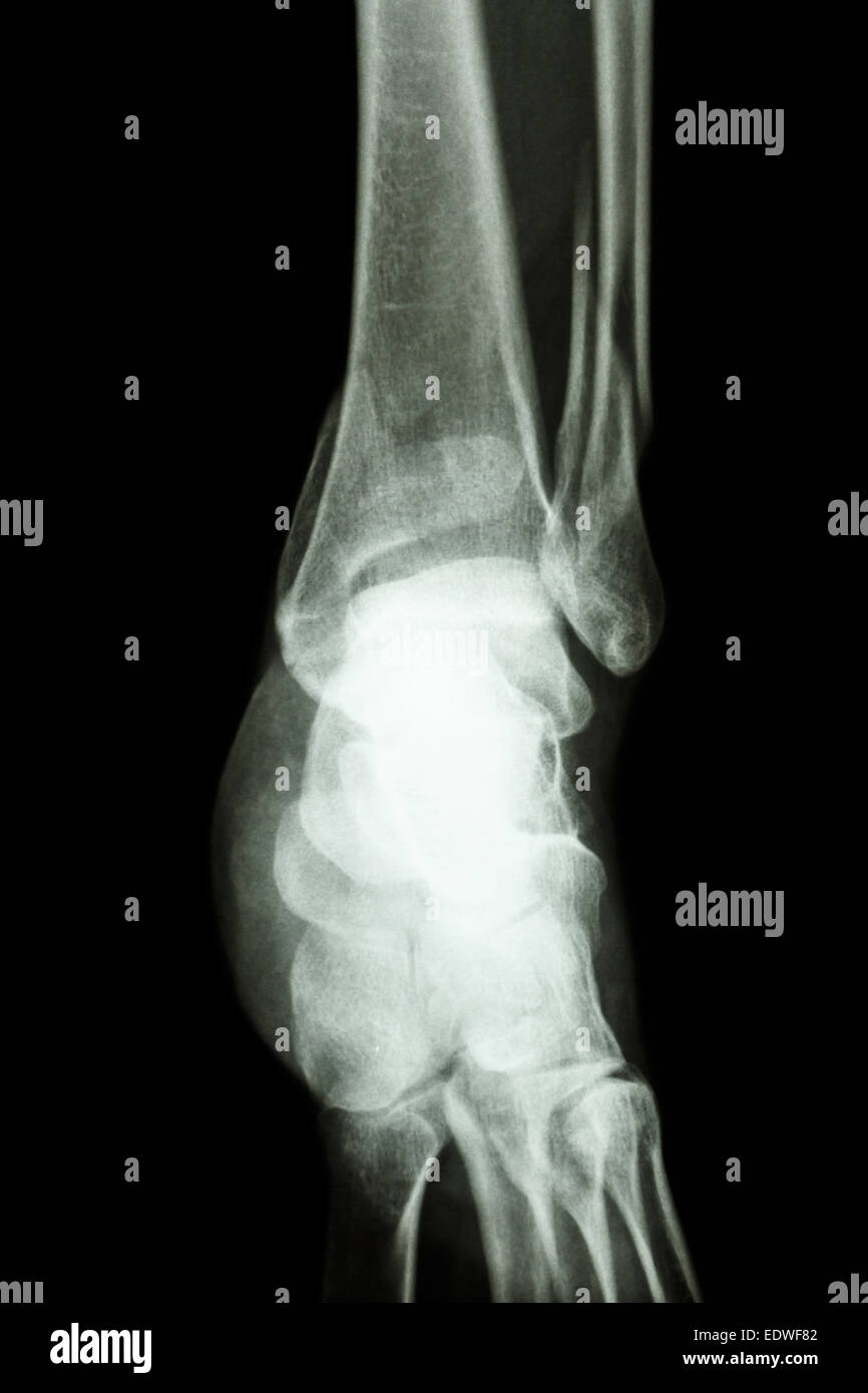 film x-ray ankle show fracture distal tibia and fibula (leg's bone) Stock Photo