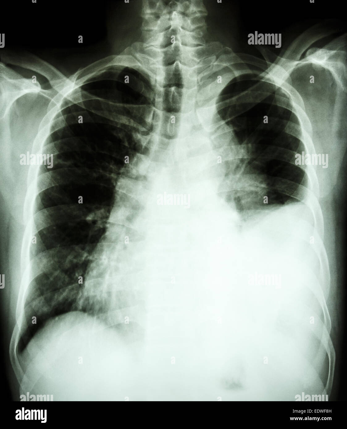 film chest X-ray PA upright : show pleural effusion at left lung due to lung cancer Stock Photo