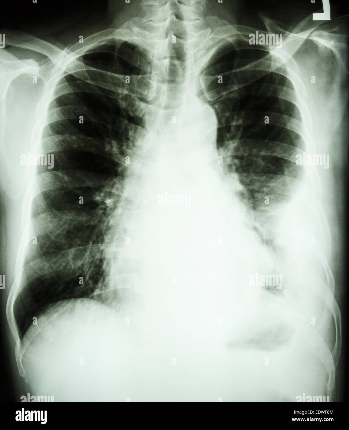film chest X-ray PA upright : show pleural effusion at left lung due to lung cancer Stock Photo