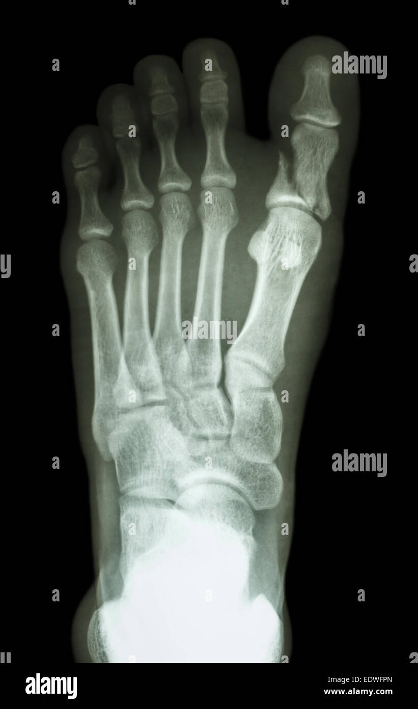 film x-ray show fracture proximal phalange at first toe Stock Photo