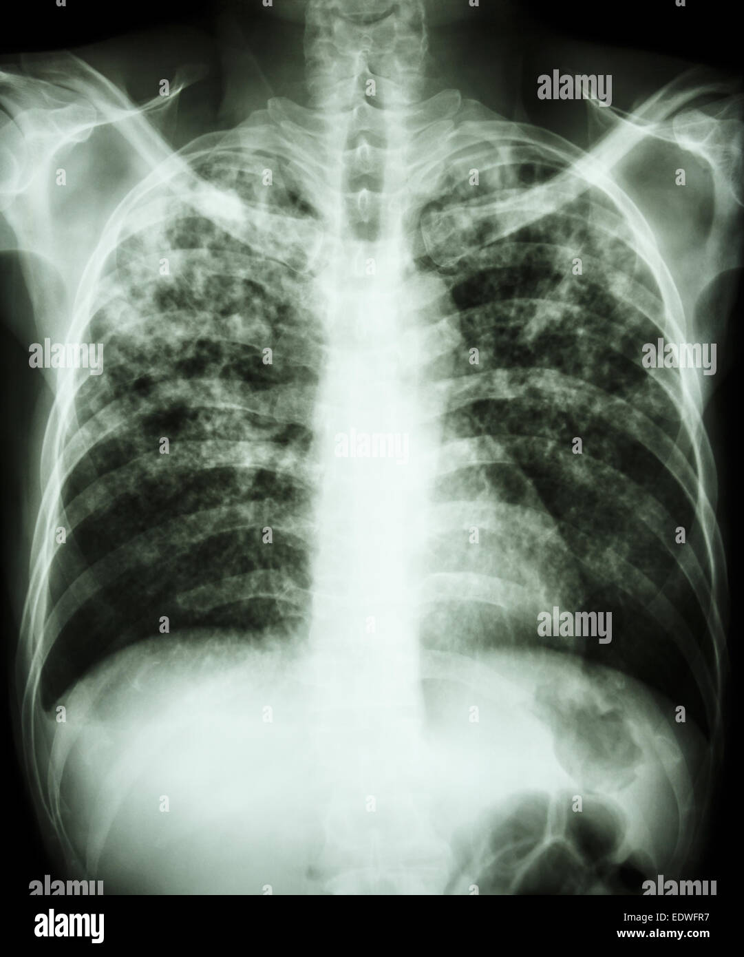 Tuberculosis Lung X Ray