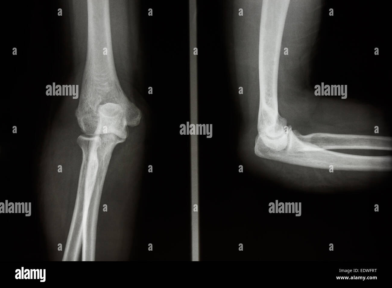 film x-ray elbow AP/Lateral : normal human's elbow Stock Photo