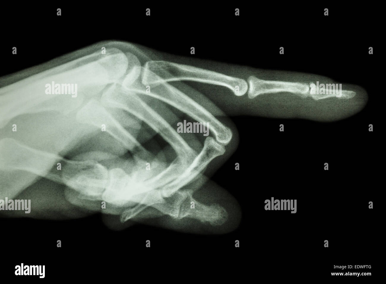 human is pointing the finger (film x-ray) Stock Photo