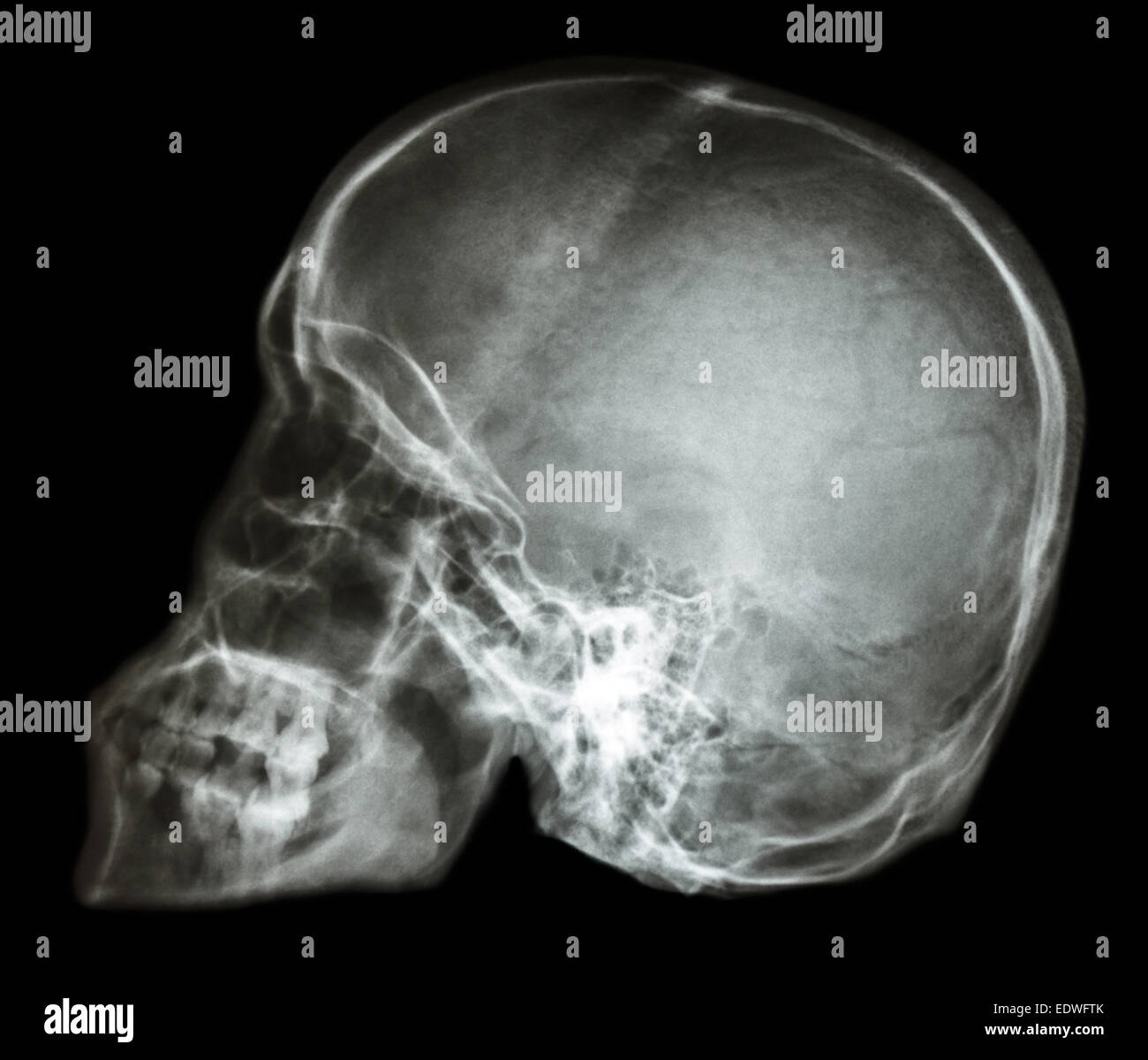 Skull X Ray Anatomy
