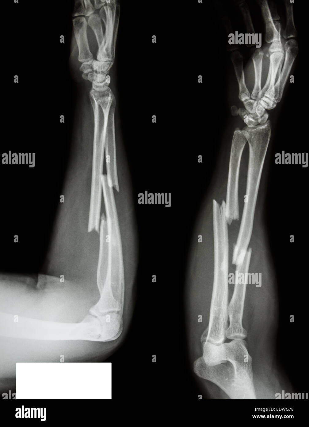 fracture shaft of radius & ulnar bone Stock Photo
