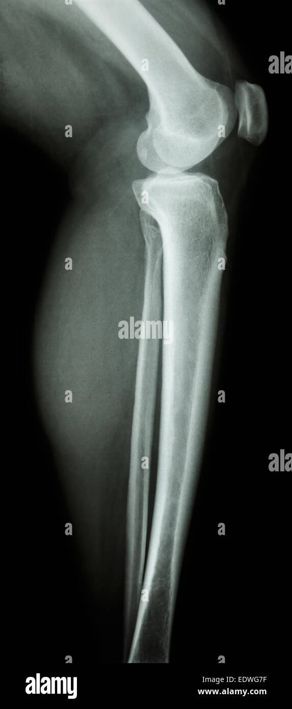 film x-ray knee lateral : normal human's knee&leg Stock Photo