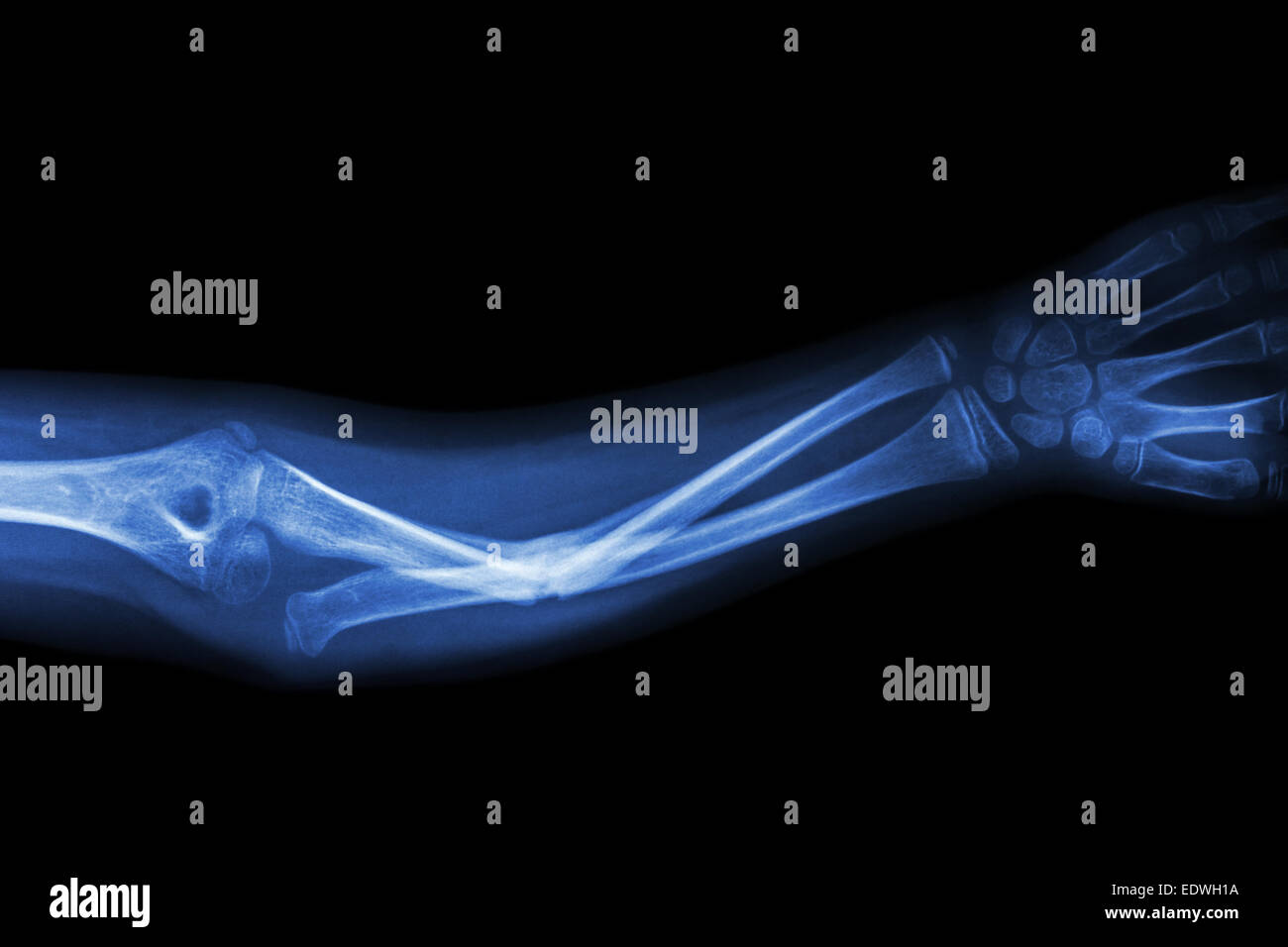 Fracture ulnar bone (forearm bone) Stock Photo