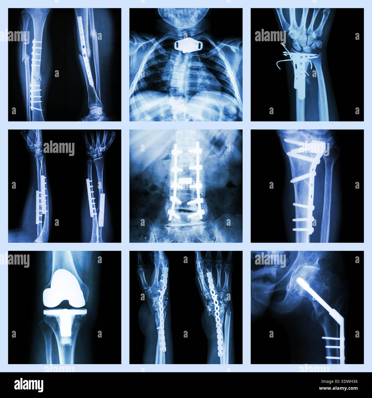 Broken Back X Ray Human