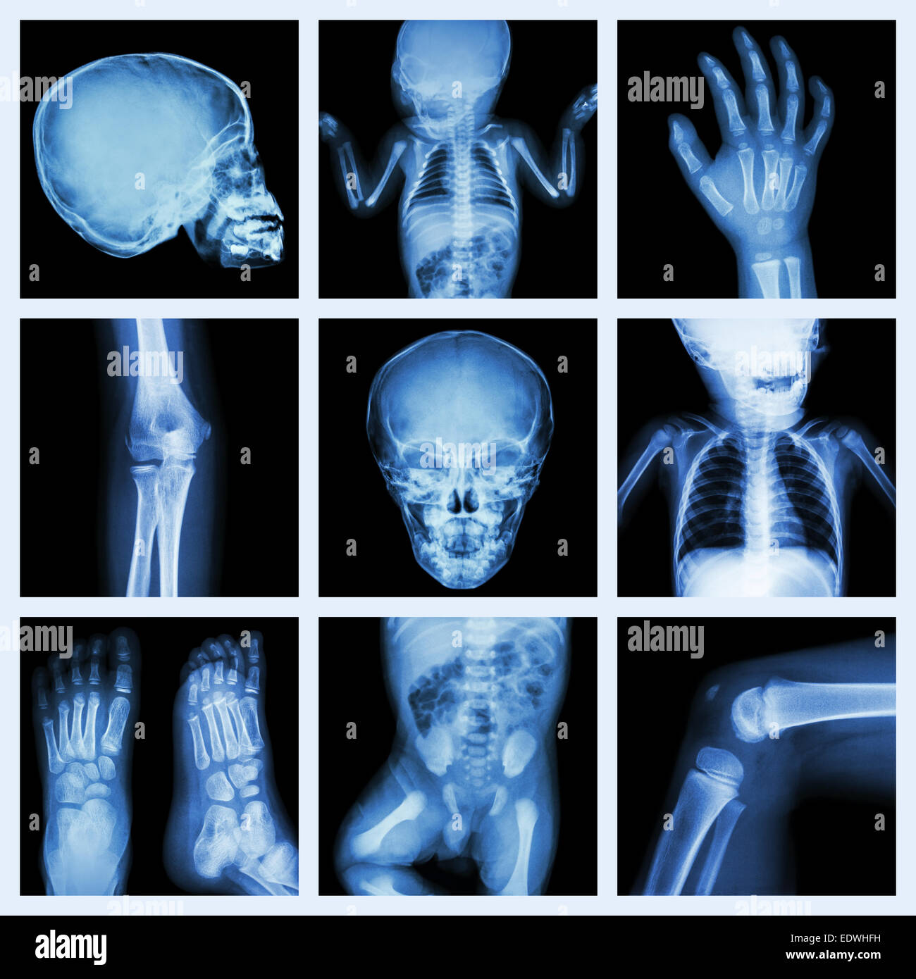 Collection x-ray part of child body (Version 2) Stock Photo