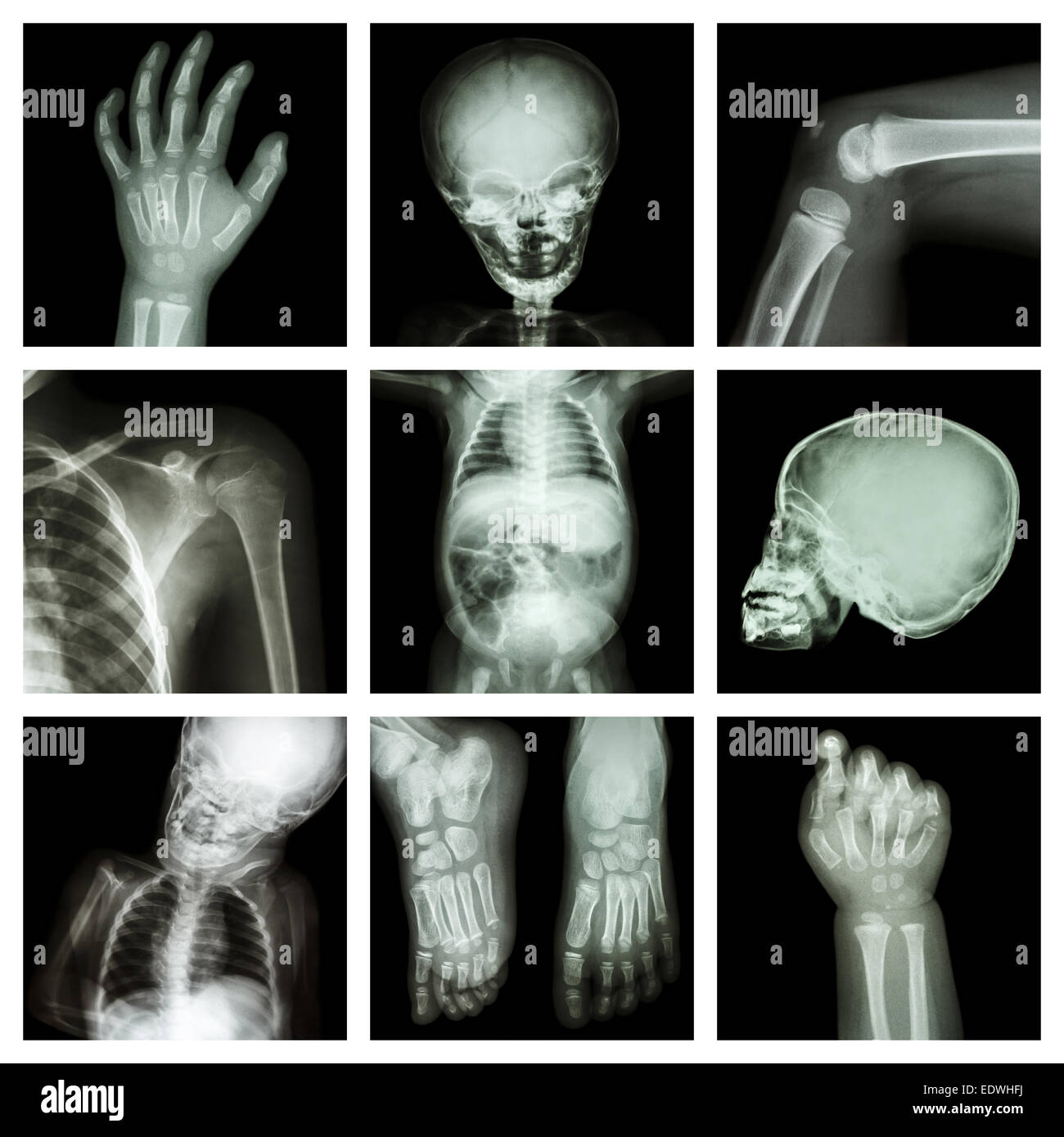 Collection x-ray part of child body Stock Photo