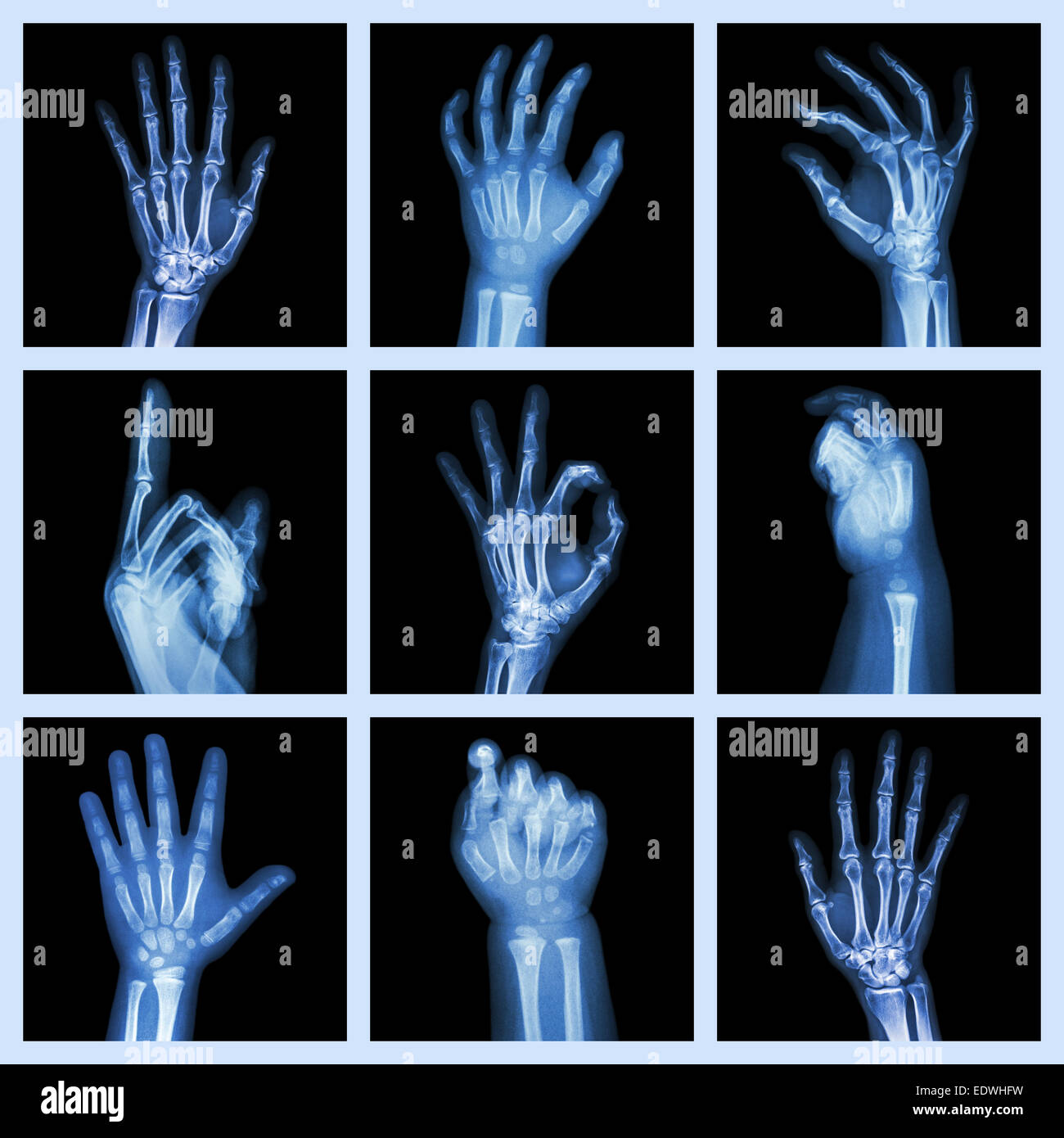 Collection x-ray of hands Stock Photo