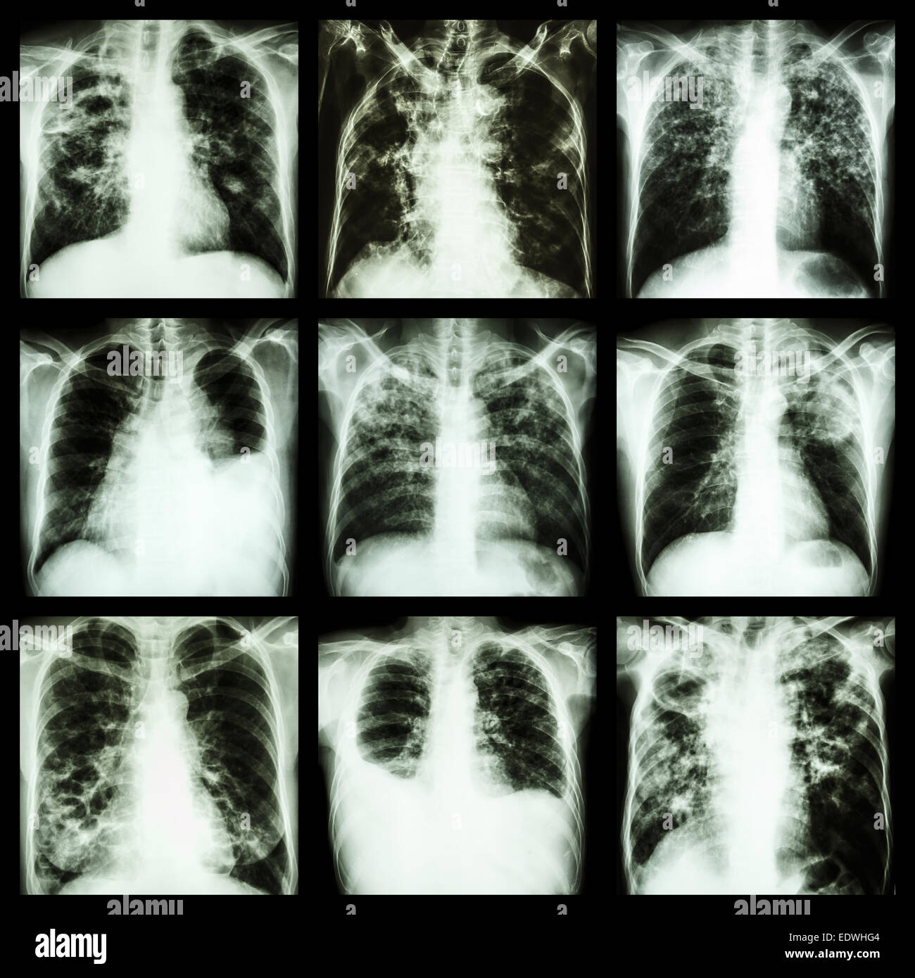 Collection of lung disease (Pulmonary tuberculosis,Pleural effusion,Bronchiectasis) Stock Photo