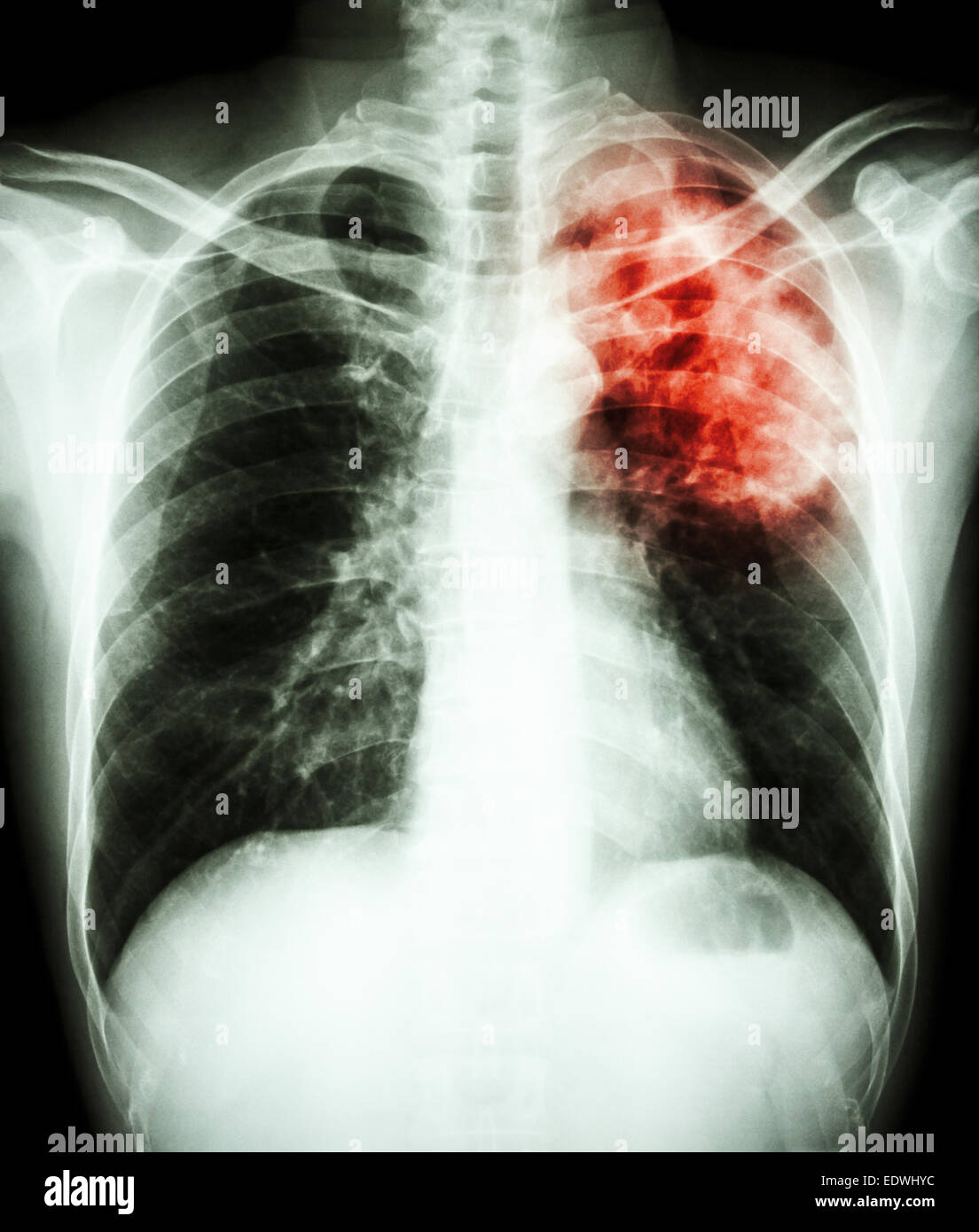 film chest xray show alveolar infiltrate at left upper lung due to