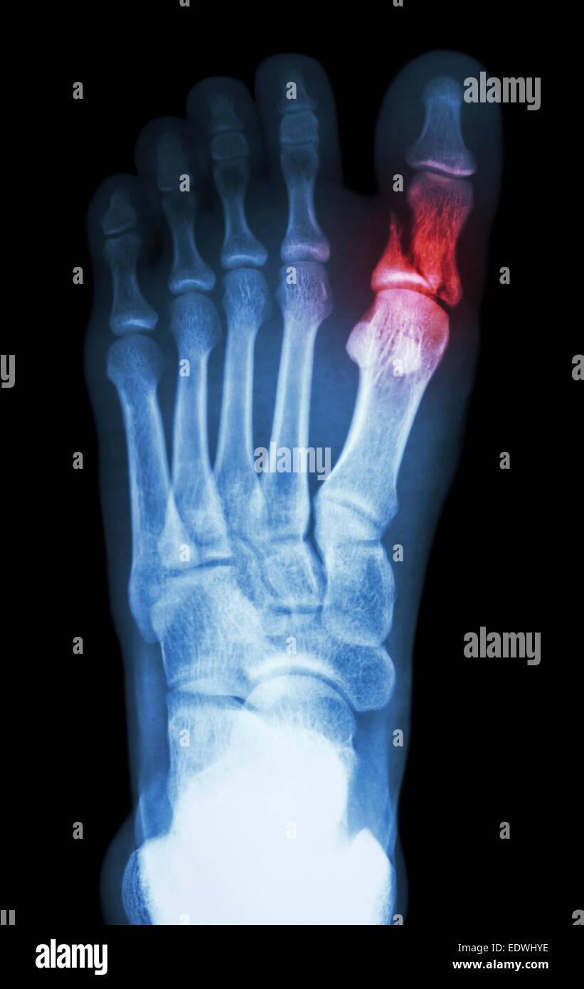 film x-ray show fracture proximal phalange at first toe Stock Photo