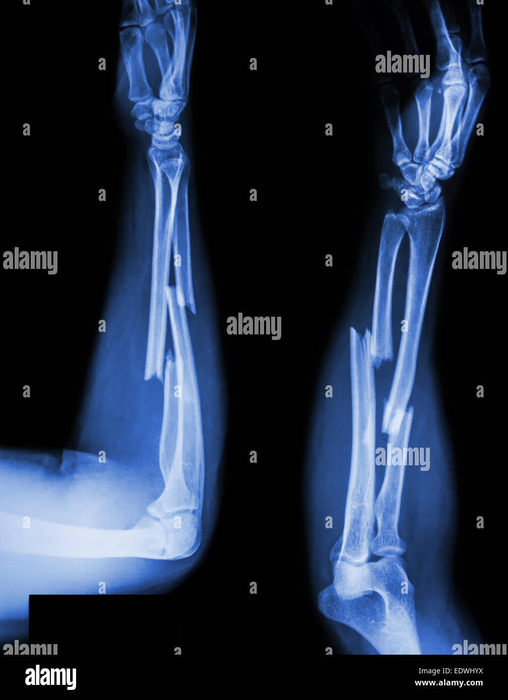 fracture shaft of radius & ulnar bone Stock Photo - Alamy