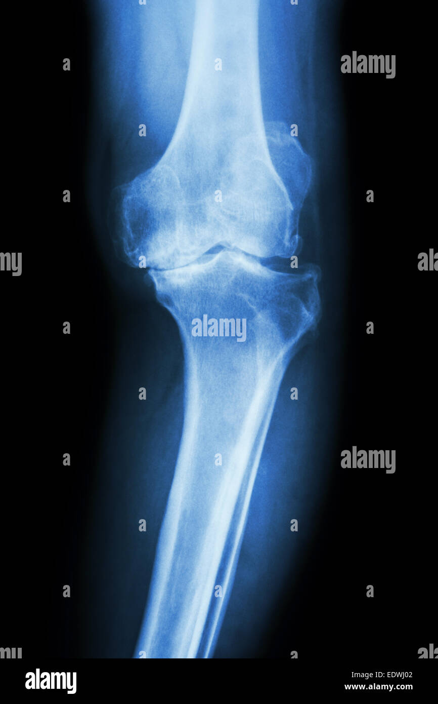 Knee osteoarthritis xray hires stock photography and images Alamy