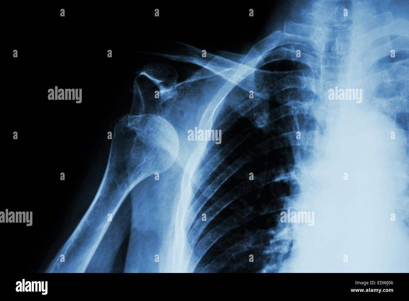Xray anterior shoulder dislocation Stock Photo Alamy