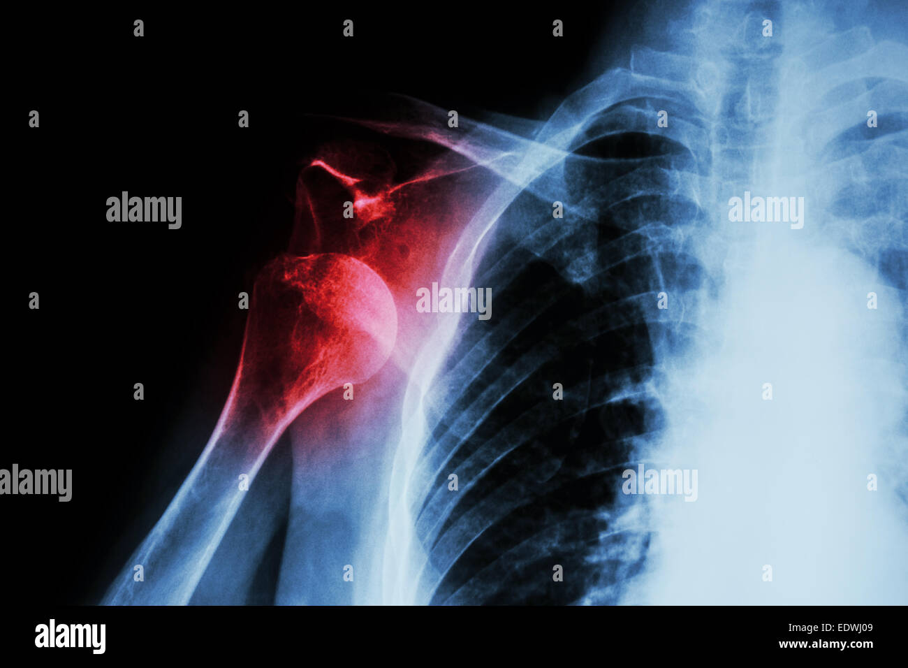 Xray anterior shoulder dislocation Stock Photo Alamy