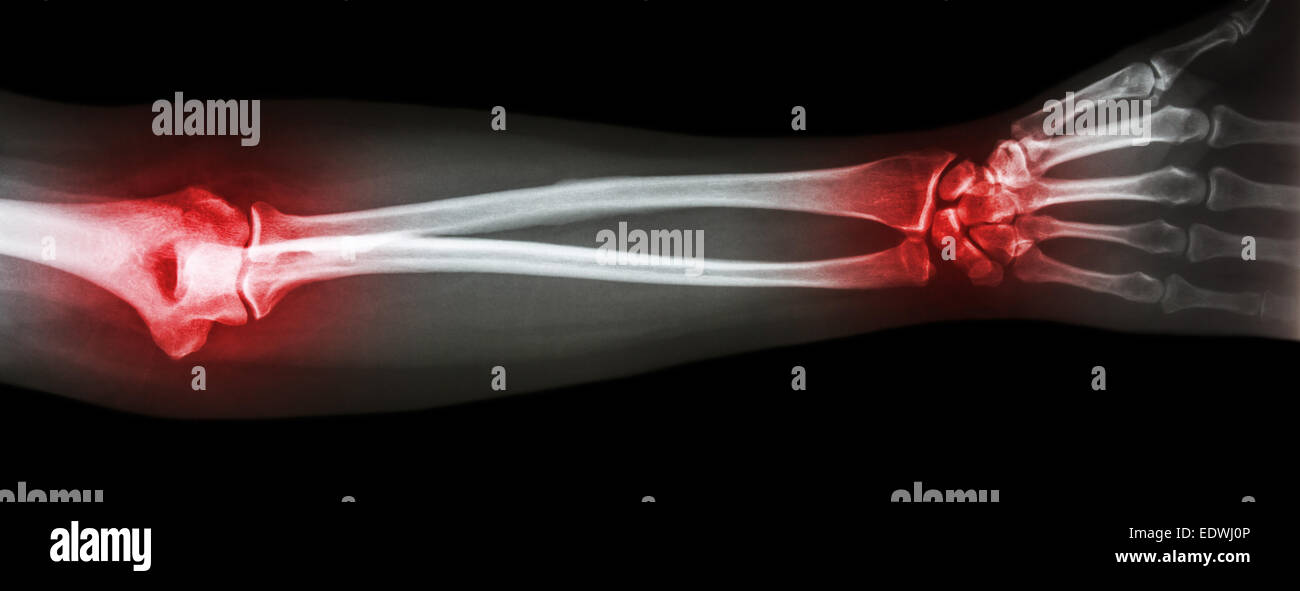 Xray forearm with arthritis at wrist and elbow (Rheumatoid,Gout Stock
