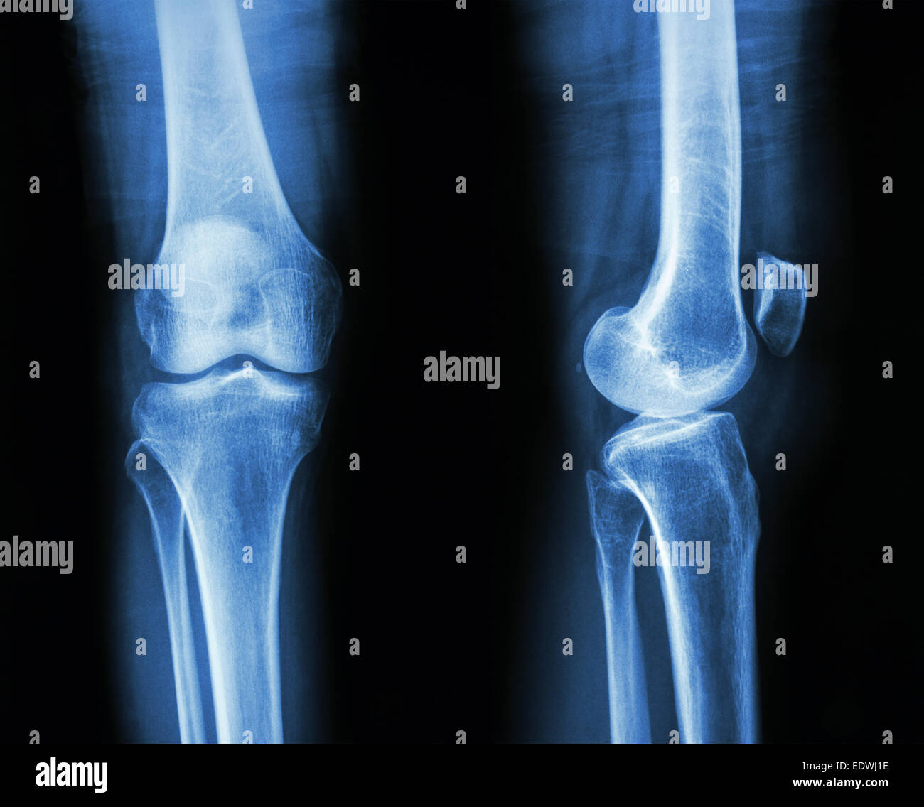 Film x-ray knee AP/lateral : show normal human's knee Stock Photo