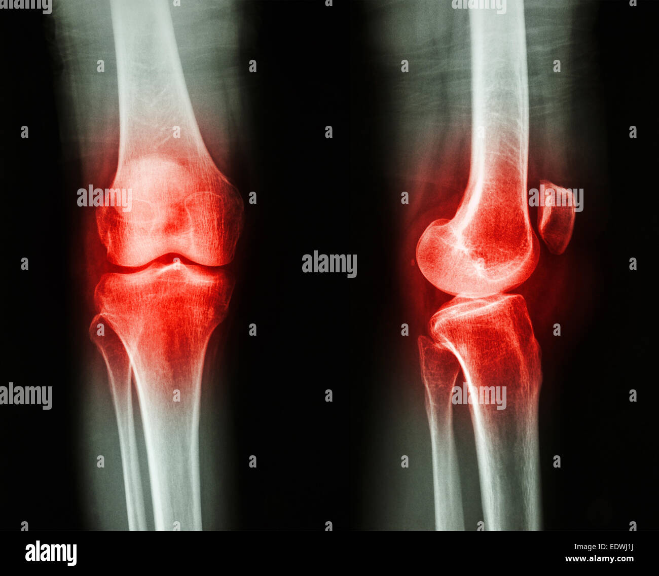 Film x-ray knee AP/lateral : Osteoarthritis knee (Inflammation at knee) Stock Photo