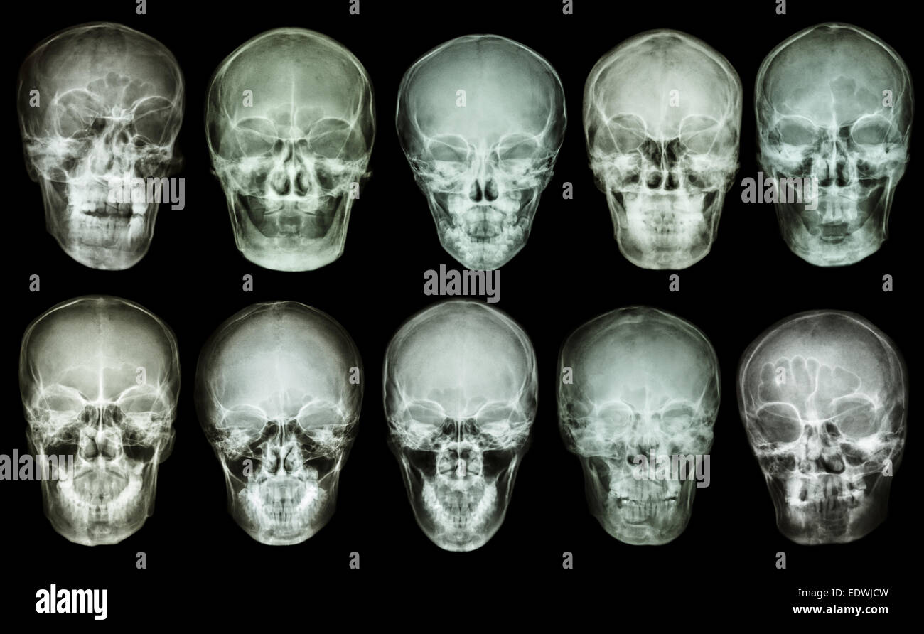 Collection of asian skull (anterior view) (Thai people) Stock Photo
