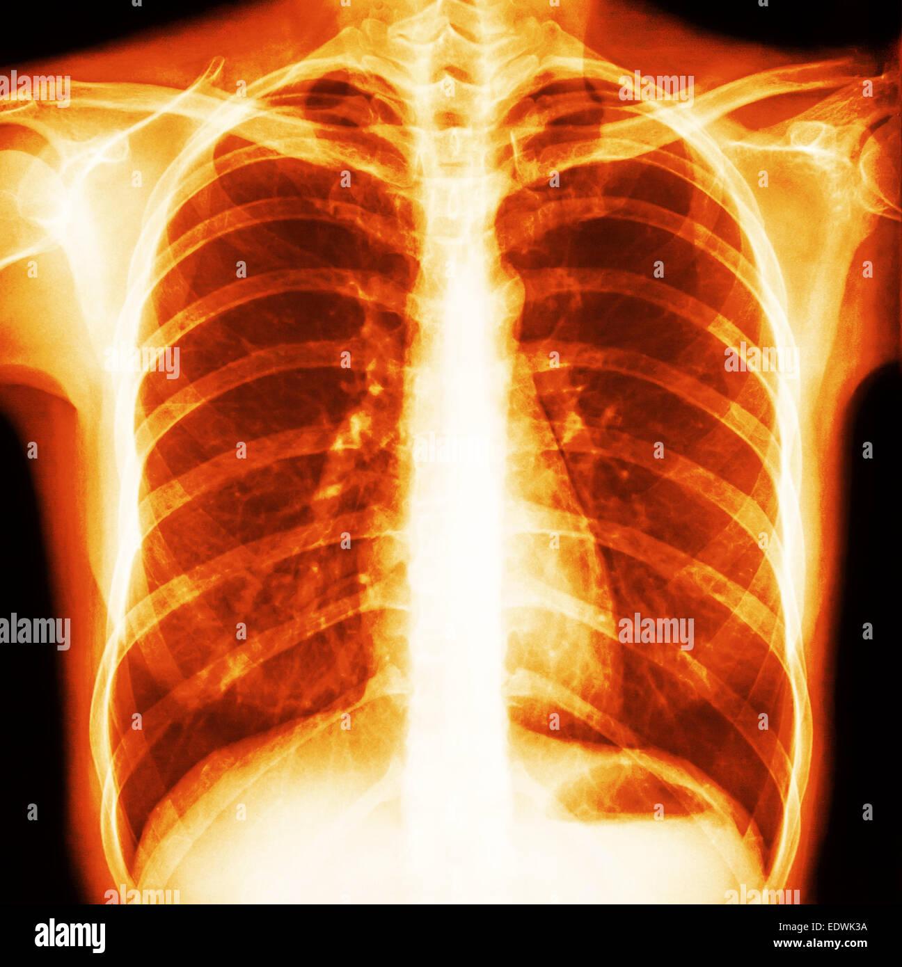 Film chest x-ray PA upright : show normal human's chest Stock Photo