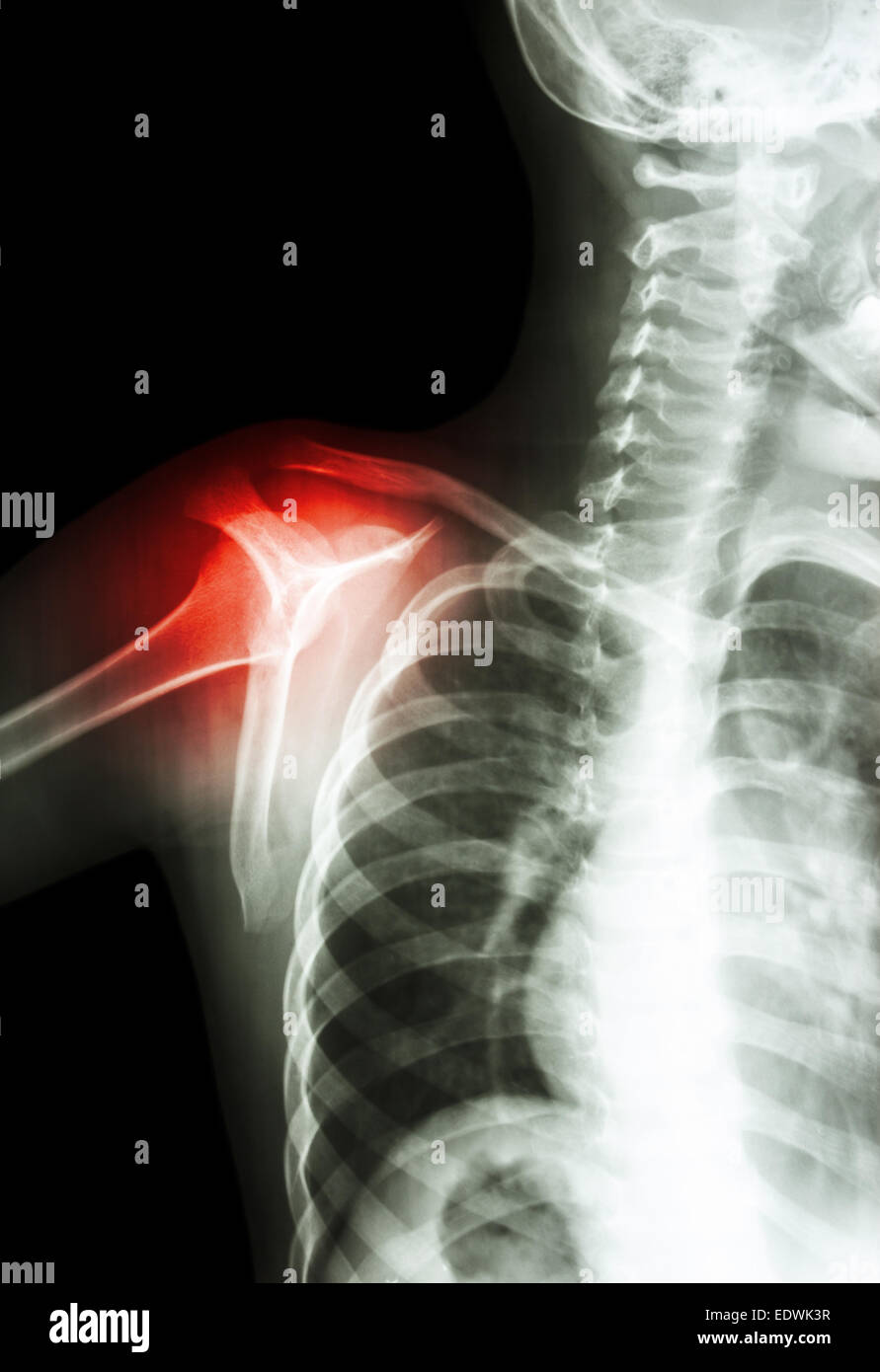 film xray transcapula Y view show child's shoulder and arthritis at