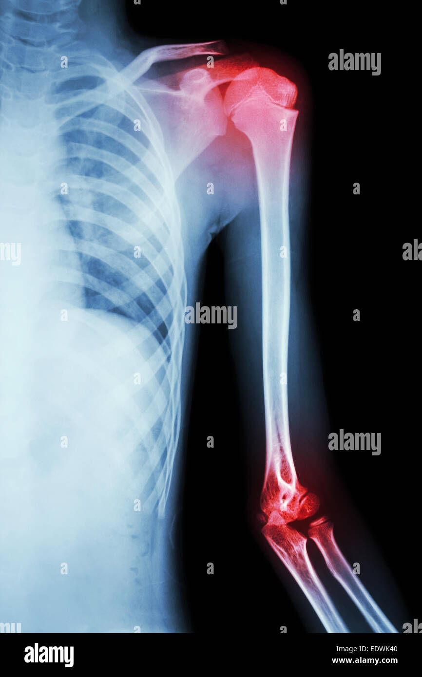 film xray left shoulder and arthritis at shoulder and elbow Stock