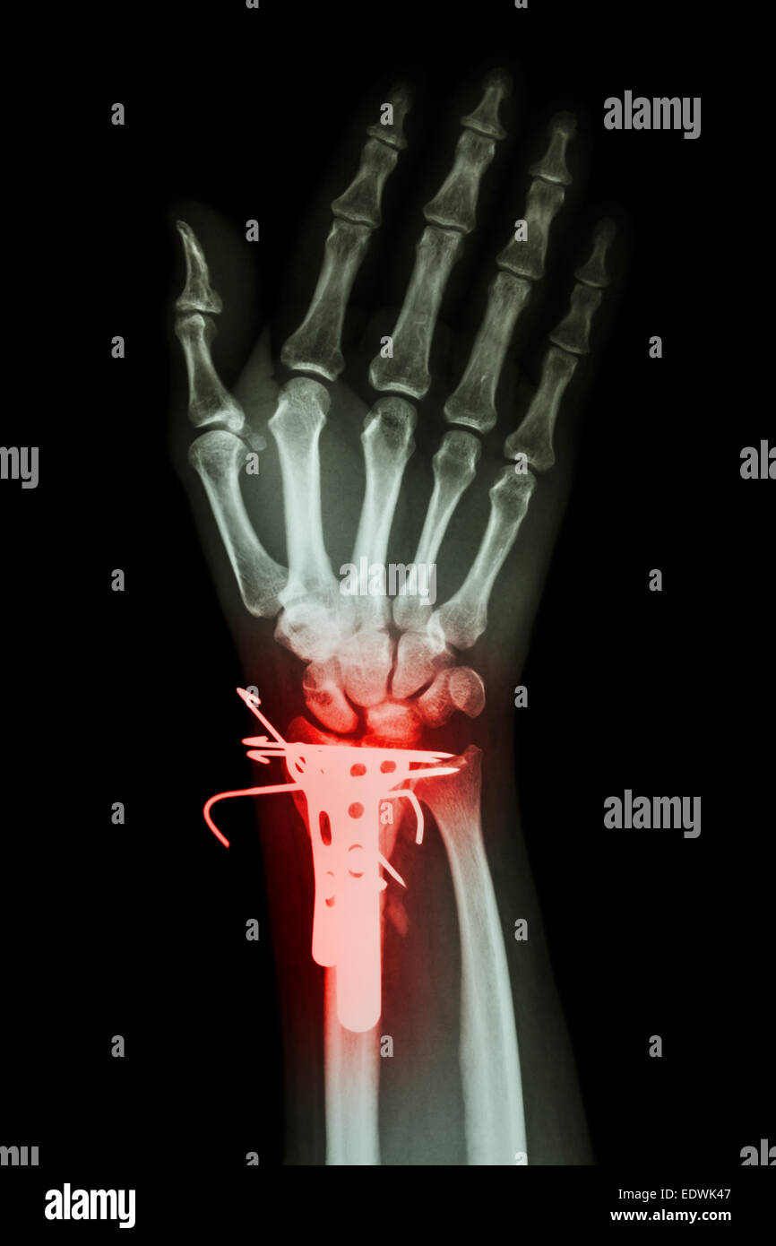 film x-ray wrist AP : show fracture distal radius (forearm's bone). It was operated and inserted plate and K-wire(Kirschner wire Stock Photo