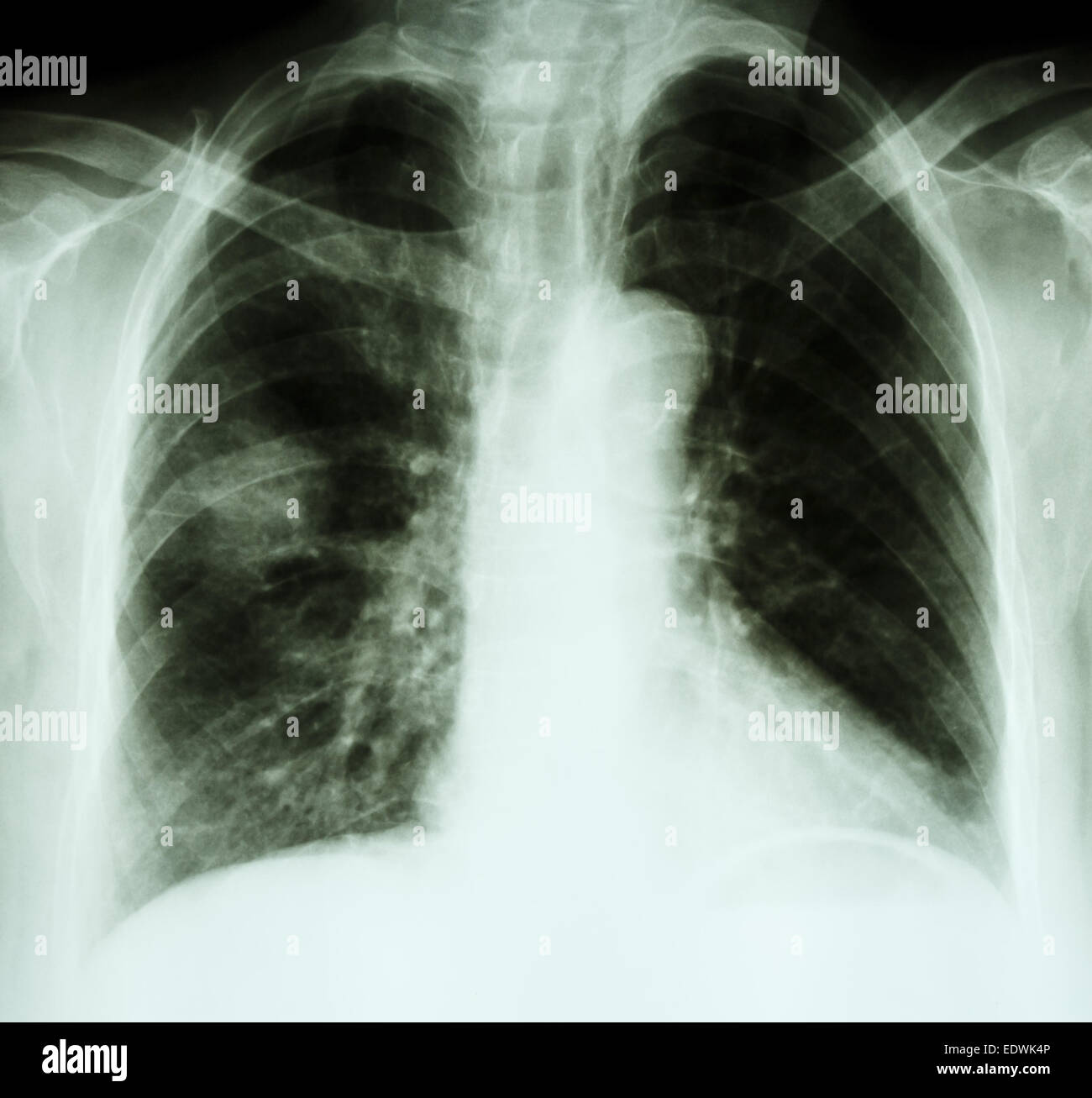 X-ray chest of lung cancer patient(opacity at right lung) Stock Photo