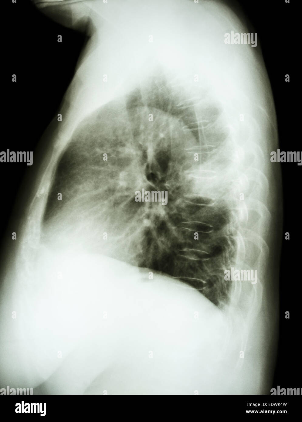 chest xray cancer