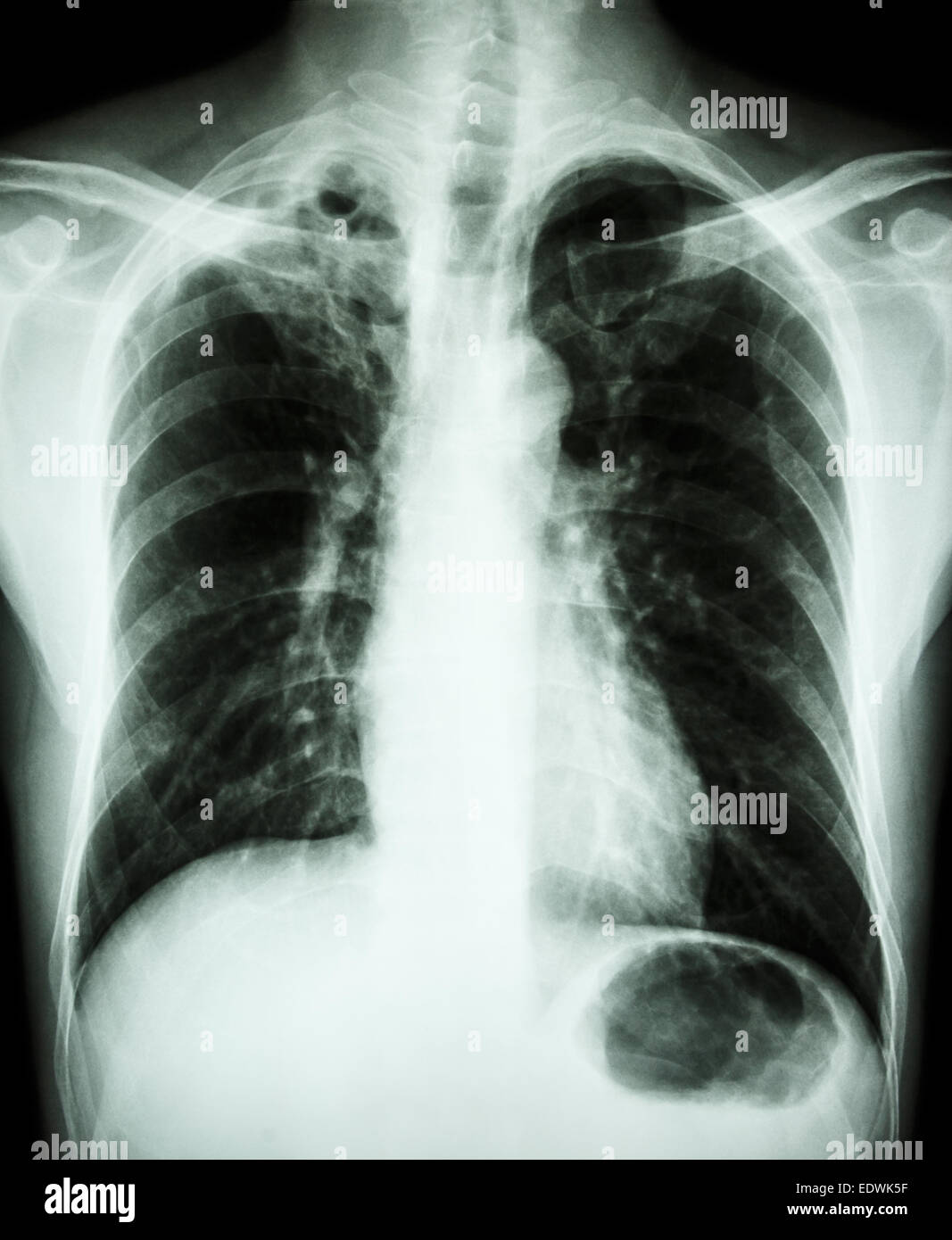 'Pulmonary Tuberculosis'  Film chest x-ray : cavity and interstitial infiltration at right upper lung due to Mycobacterium tuber Stock Photo