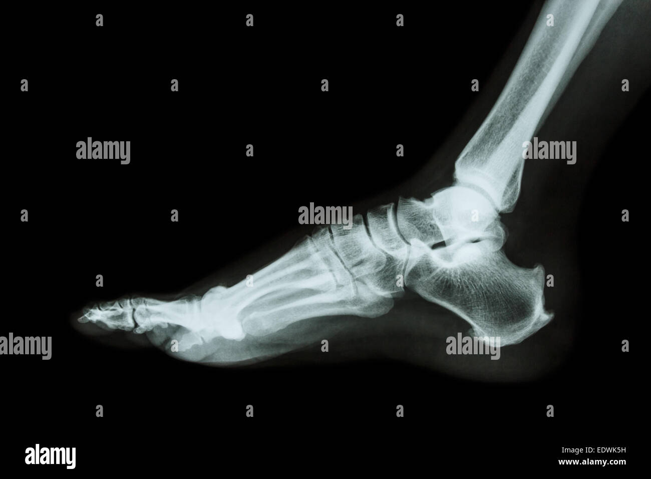 X-ray normal foot lateral Stock Photo