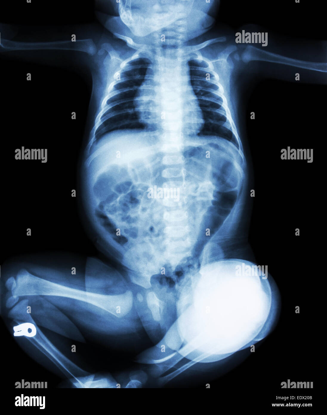 Infant x ray hires stock photography and images Alamy