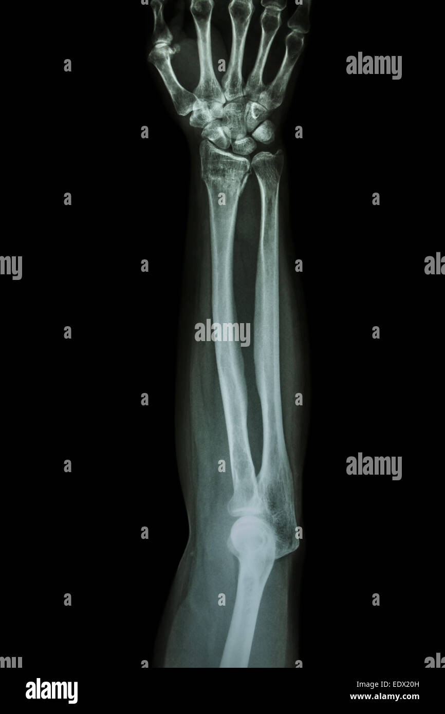 Fracture distal radius (wrist bone) ,(Colles' fracture) Stock Photo
