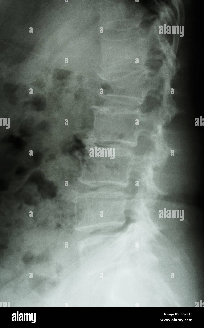Film x-ray lumbar spine lateral : show burst fracture at lumbar spine (collapse at body of lumbar spine) Stock Photo