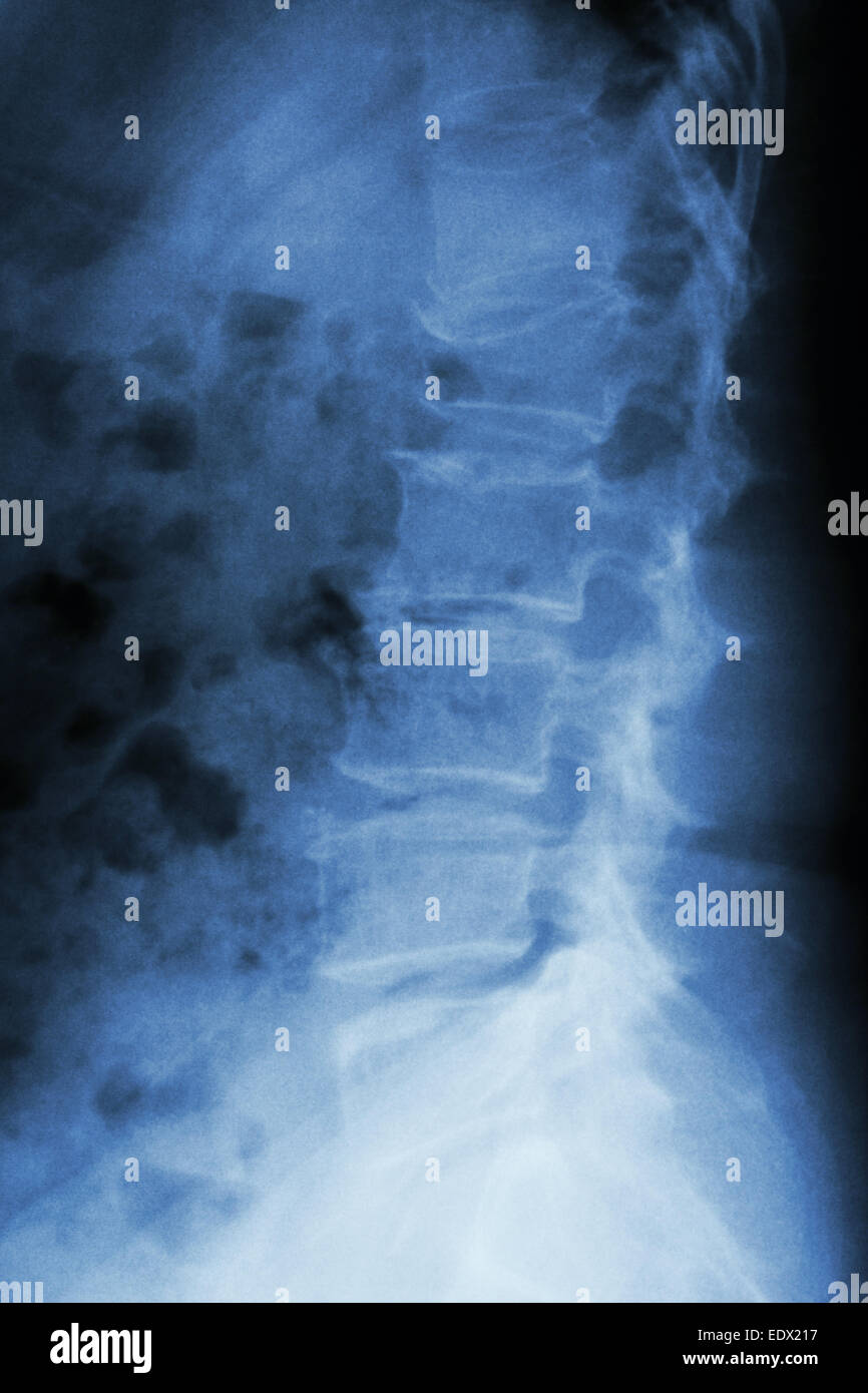 Film x-ray lumbar spine lateral : show burst fracture at lumbar spine (collapse at body of lumbar spine) Stock Photo