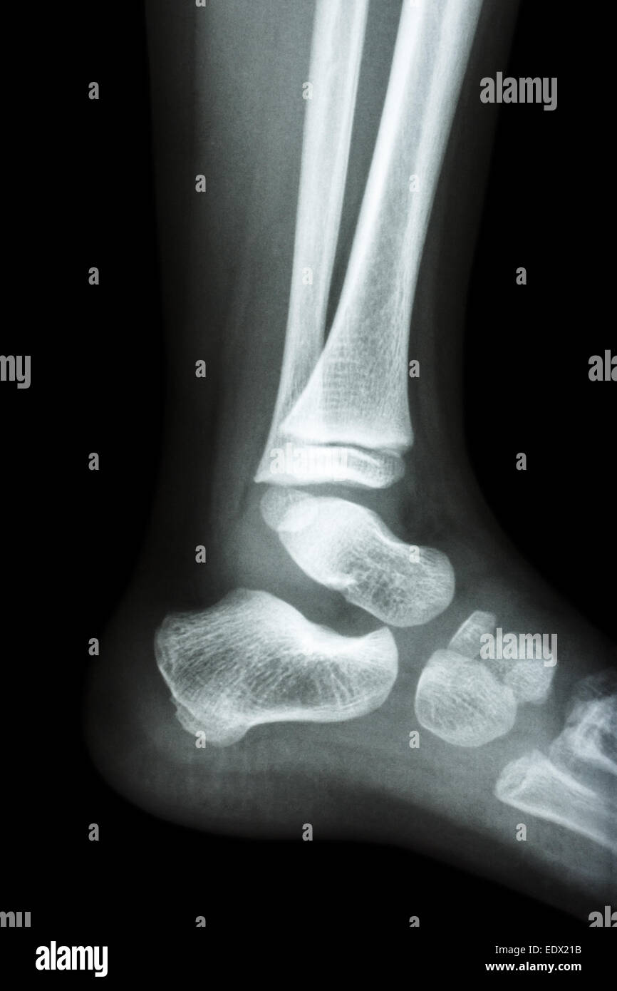 Film x-ray normal child's ankle Stock Photo