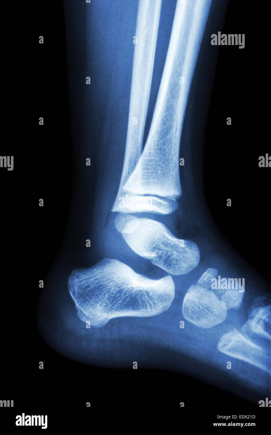 Film xray normal child's ankle Stock Photo Alamy
