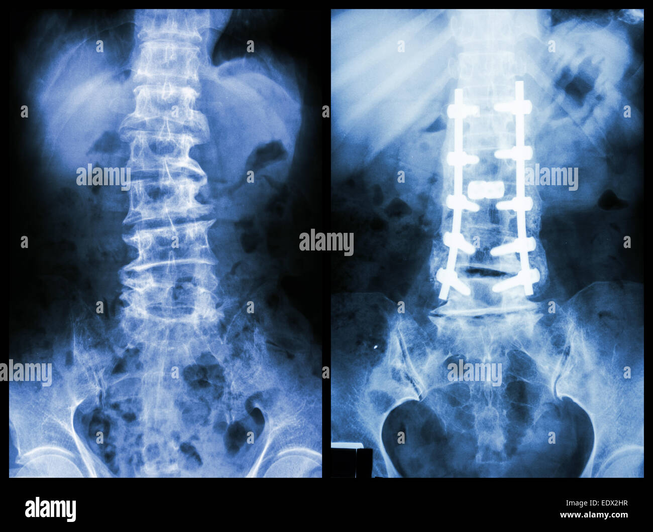 Spondylosis" (Left image) , Patient was operated and internal fixed. (Right  image Stock Photo - Alamy
