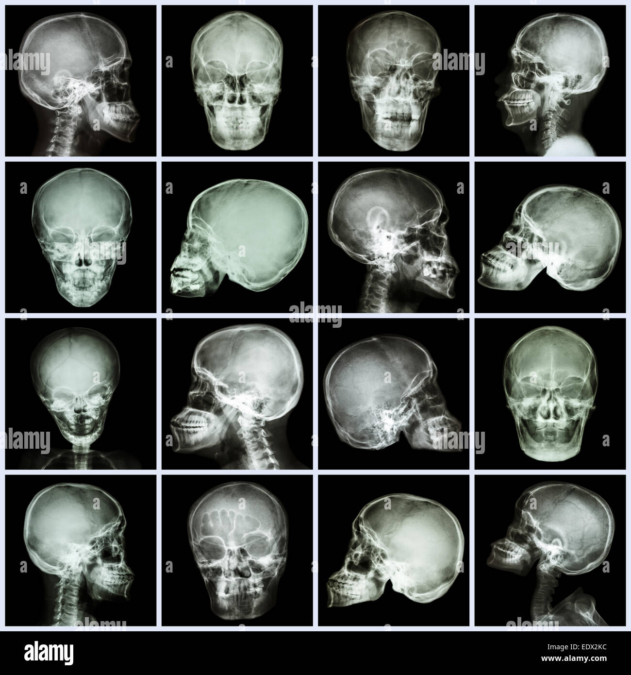 Collection x-ray skull (asian people) Stock Photo