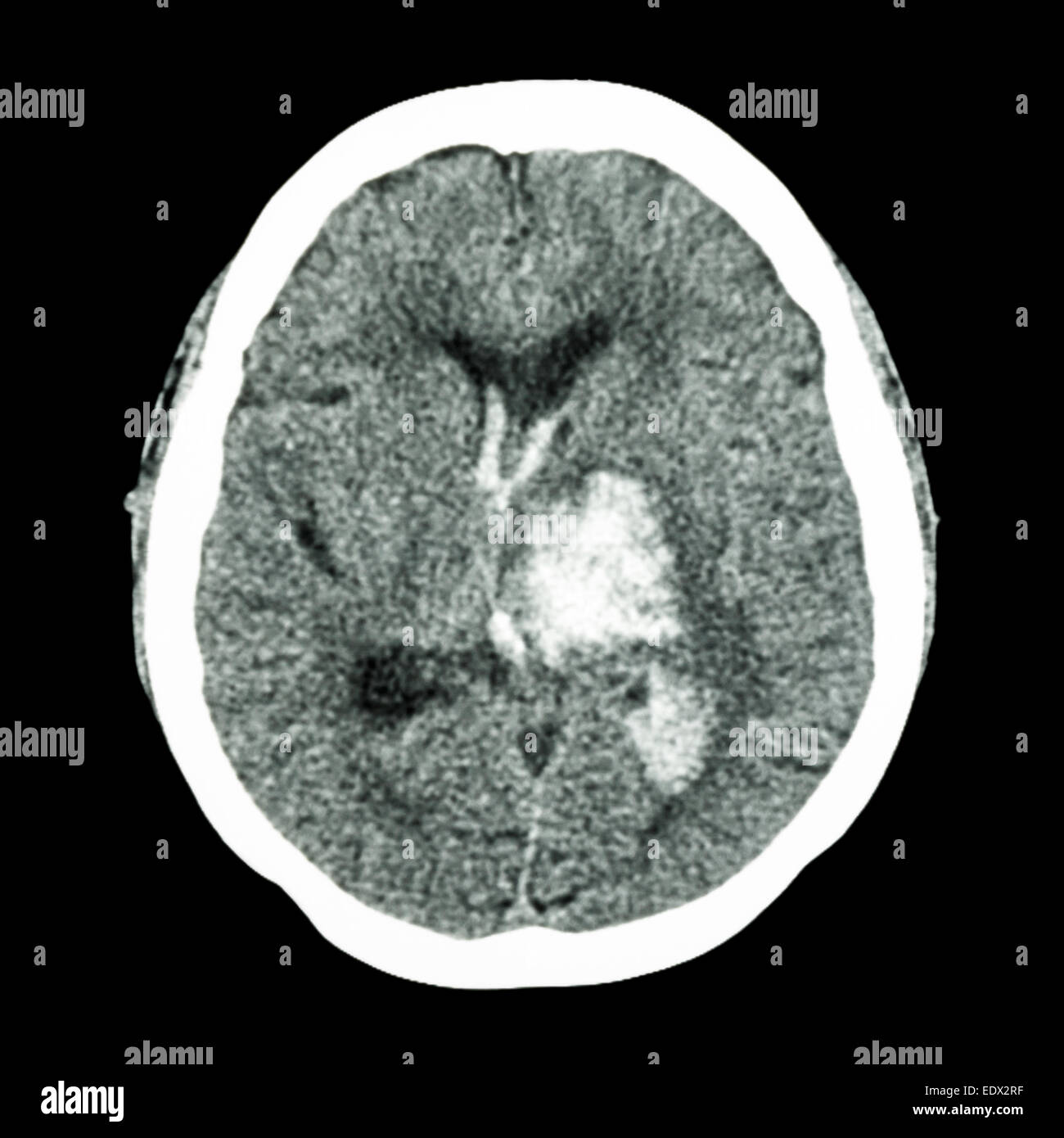 CT brain show left thalamic hemorrhage (Hemorrhagic stroke Stock