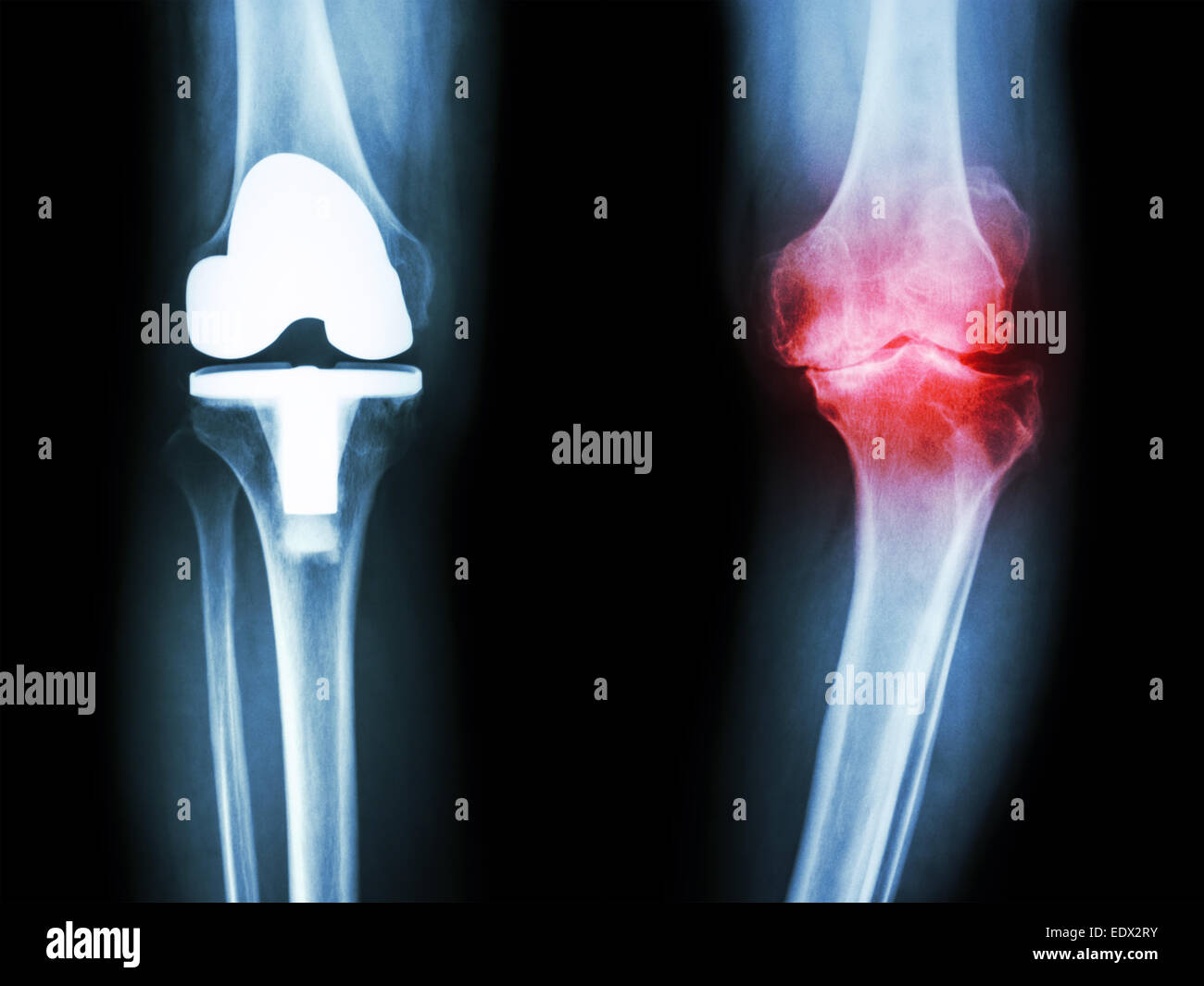Artificial knee joint hires stock photography and images Alamy