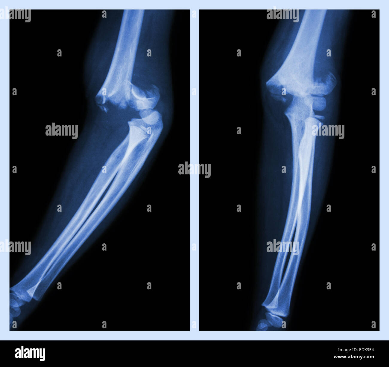 Fracture elbow (Left image side position , Right image front